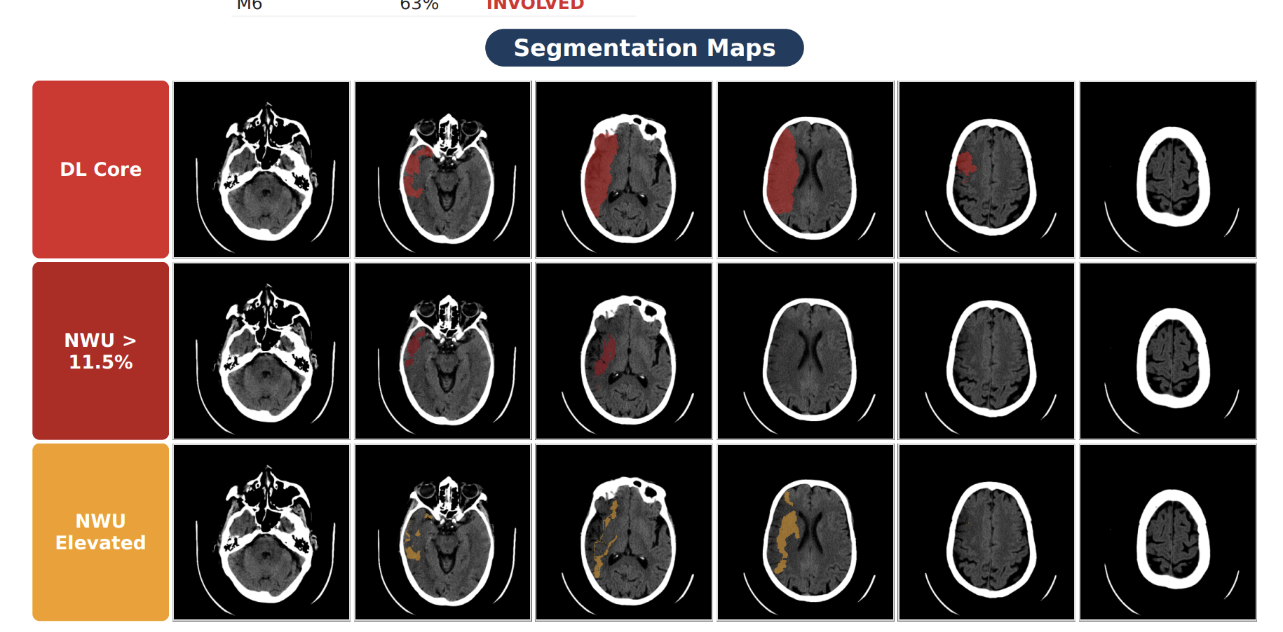 Segmentation maps on axial slices — DL core (top), NWU > 11.5% (middle) and elevated NWU band (bottom)