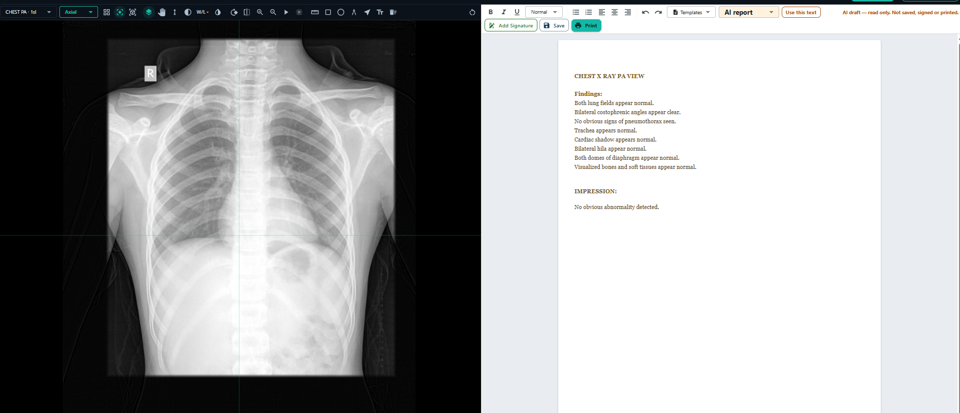 AI draft report shown beside the study in the viewer, for the radiologist to review, edit and sign