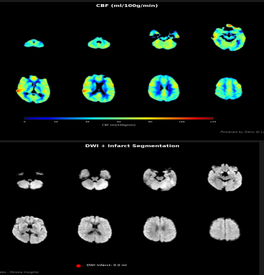 MRI ASL Insightz — Absolute CBF · DWI segmentation