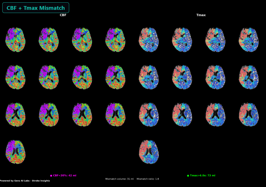 CT Stroke Insightz — CBF + Tmax mismatch