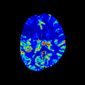 CT Stroke Insightz — rCBF