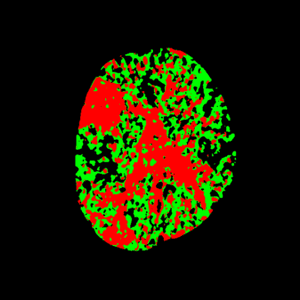 CT Stroke Insightz — Tmax