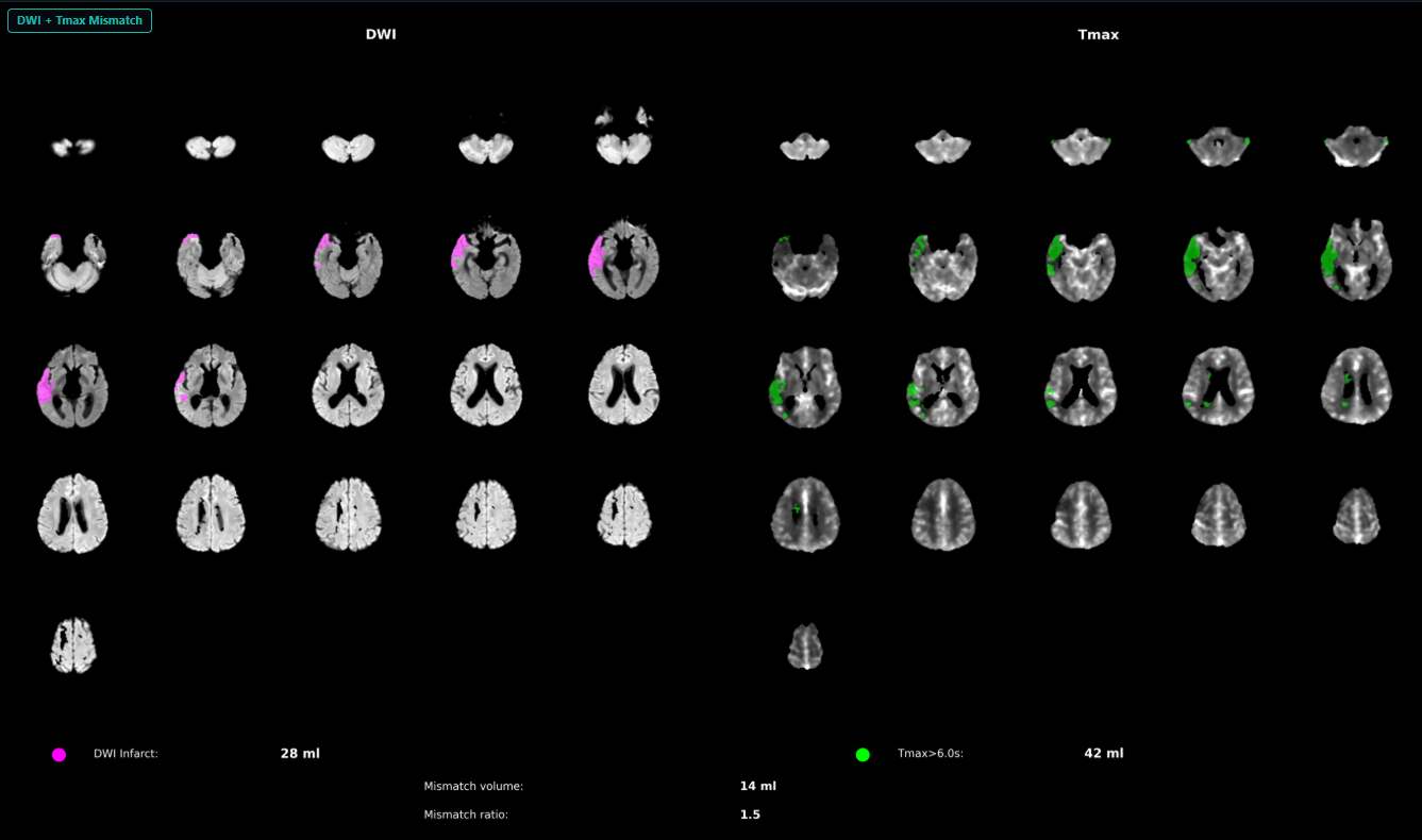 MR Stroke Insightz — DWI + Tmax mismatch