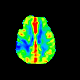 MR Stroke Insightz — rCBF