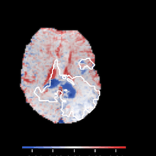MRI Tumor Insightz — K2 leakage coefficient