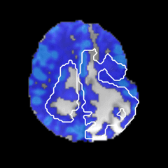 MRI Tumor Insightz — Leakage-corrected nCBV
